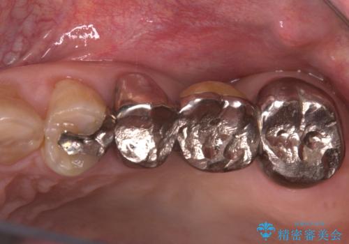 奥歯の奥側からよく汚れが出てくるの症例 治療前