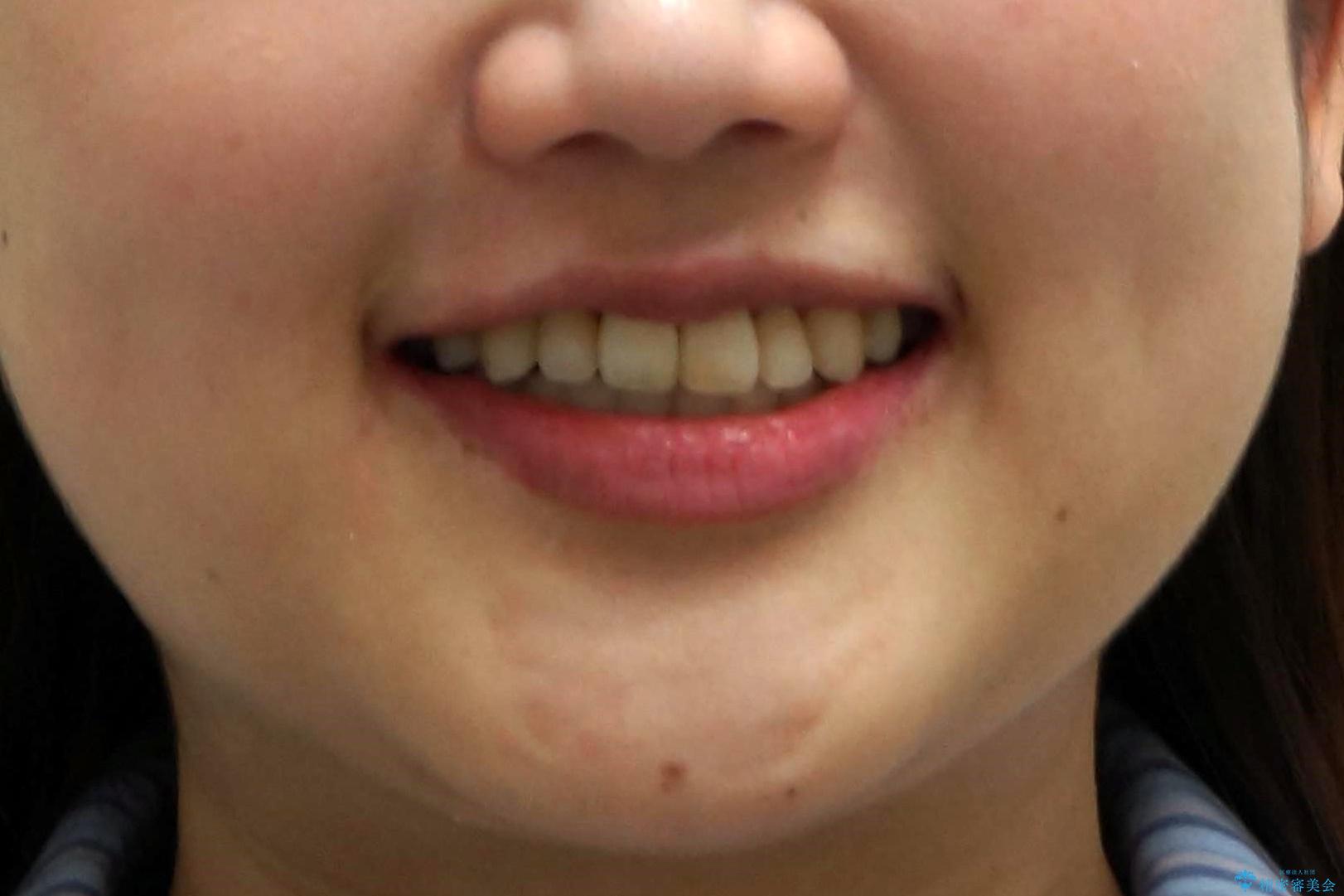 難症例　奥歯がかみ合っていない　歯並び矯正で別人にの治療後（顔貌）