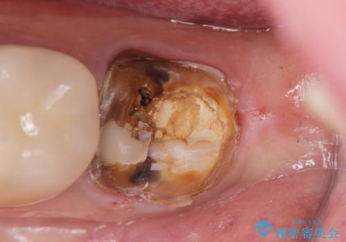 割れたクラウン 再発した虫歯の治療の治療前
