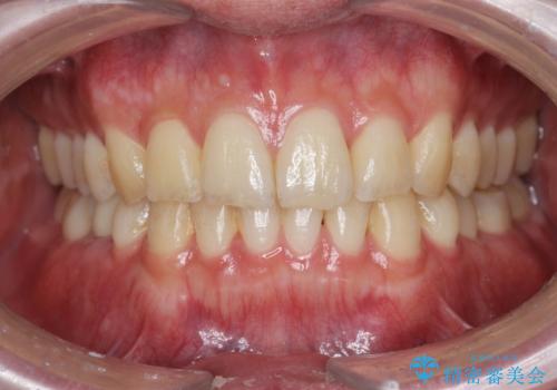 前歯のがたつきをなおしたい マウスピース矯正の症例 治療後
