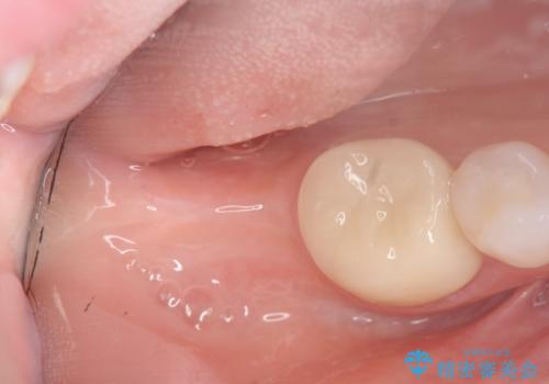 伸びてしまった奥歯、咬合平面を揃えたインプラント治療の治療前