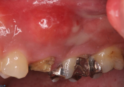歯茎が腫れる　インプラントでの治療