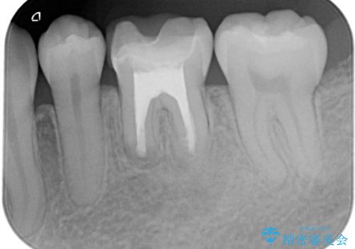 外科的歯内療法の症例 治療後