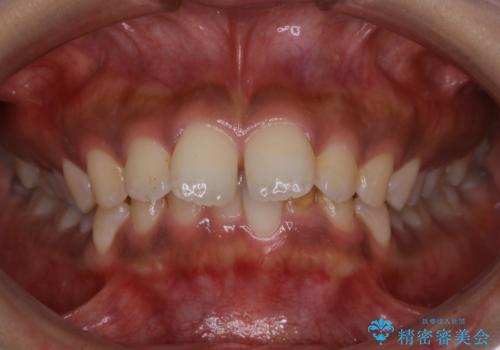 インビザライン矯正　歯を抜かずに出っ歯を改善!の症例 治療前