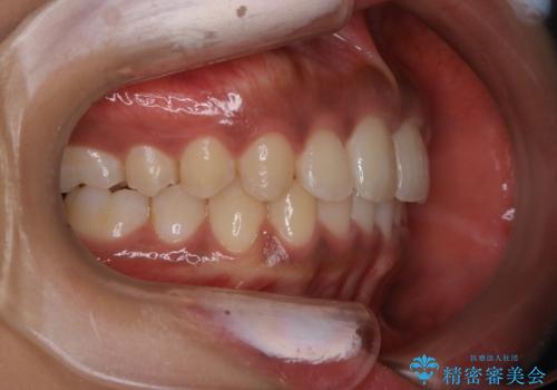 インビザライン矯正 歯を抜かずに出っ歯を改善!の治療後