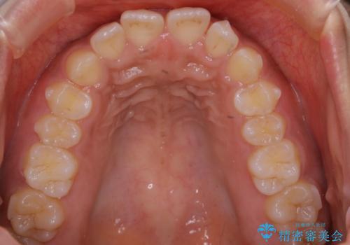 インビザライン矯正 歯を抜かずに出っ歯を改善!の治療中
