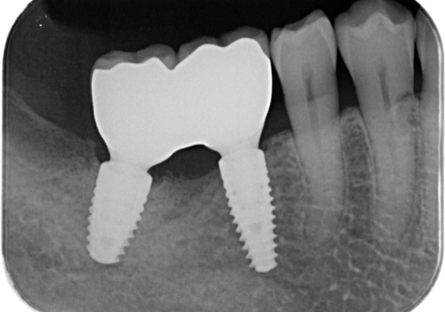 奥歯で咬むと痛いの治療後