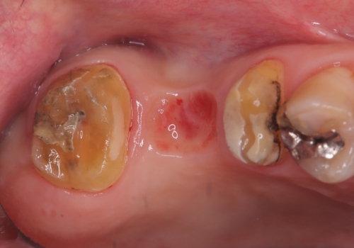 奥歯の奥側からよく汚れが出てくるの治療前
