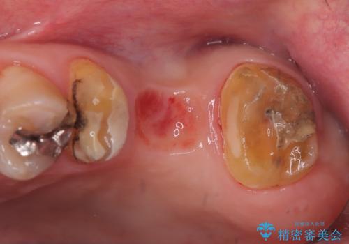 奥歯の奥側からよく汚れが出てくるの治療前
