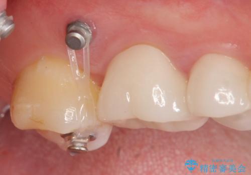 伸びてしまった奥歯、咬合平面を揃えたインプラント治療の治療中