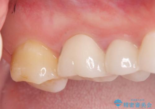 伸びてしまった奥歯、咬合平面を揃えたインプラント治療の治療中