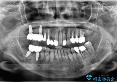 奥歯で咬むと痛いの治療後