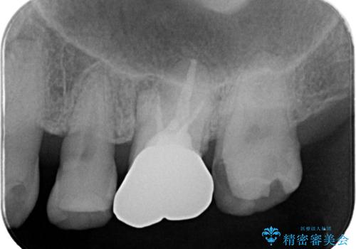 フロス通したら詰め物が取れたの治療前