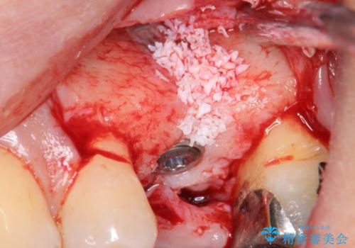 歯茎が腫れる　インプラントでの治療の治療後