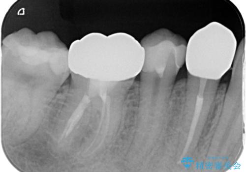 歯の形が気になる セラミックでキレイな歯に!の治療後