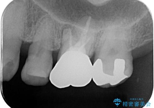 フロス通したら詰め物が取れたの治療後