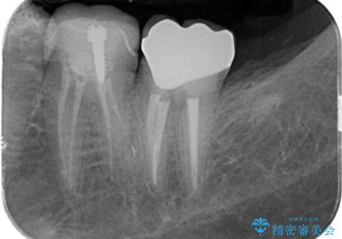 割れたクラウン 再発した虫歯の治療の治療後