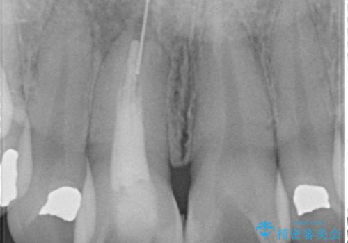 器具が破折して残ったままの前歯の治療前