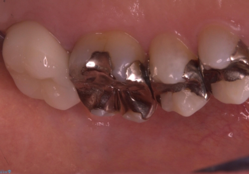 詰め物と歯の境目に穴が空いているの治療後