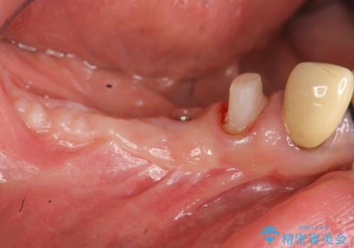 狭小な歯槽骨に対するインプラント治療の治療中