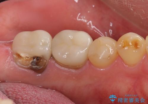 割れたクラウン 再発した虫歯の治療の治療前