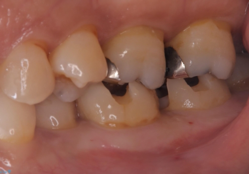 【セラミックインレー】詰め物が外れた 白くしたいの治療中