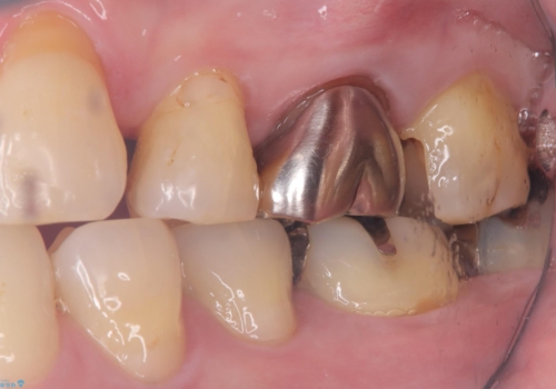 フロス通したら詰め物が取れたの治療中