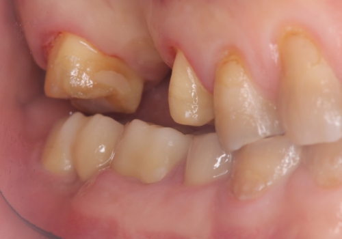 奥歯の奥側からよく汚れが出てくるの治療中