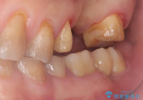 【セラミッククラウン】【ブリッジ】奥歯の奥側からよく汚れが出てくるの治療中
