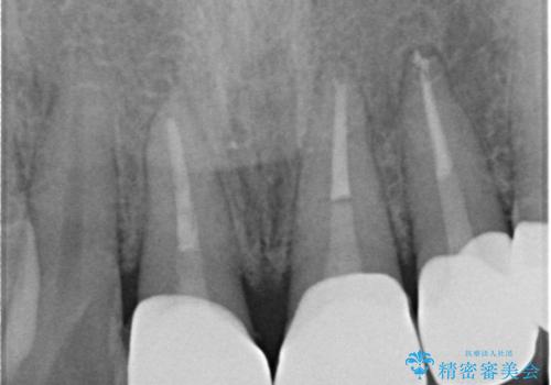 転んで前歯が欠けてぐらぐらに 歯の神経も死んでしまったの治療後