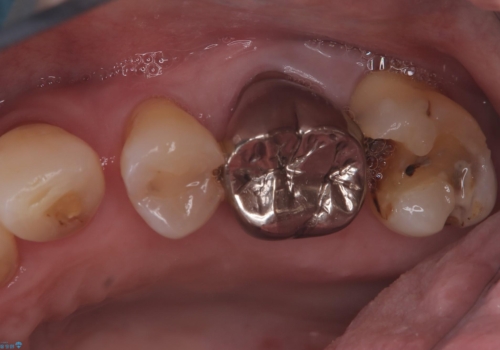 フロス通したら詰め物が取れたの治療前