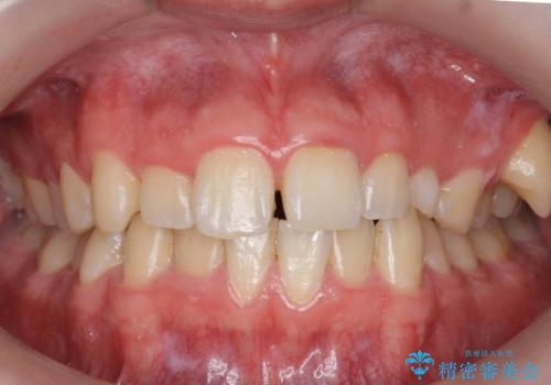 前歯のすき間、犬歯の異所萌出　乳歯を抜かずに矯正の治療前