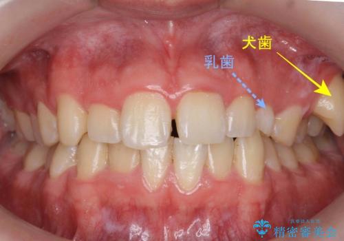 前歯のすき間、犬歯の異所萌出　乳歯を抜かずに矯正