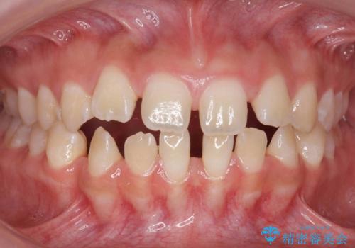 人の印象は歯並びから! 実は…美容医療より効果抜群!! コスパ重視ならすきっ歯の矯正治療の症例 治療前