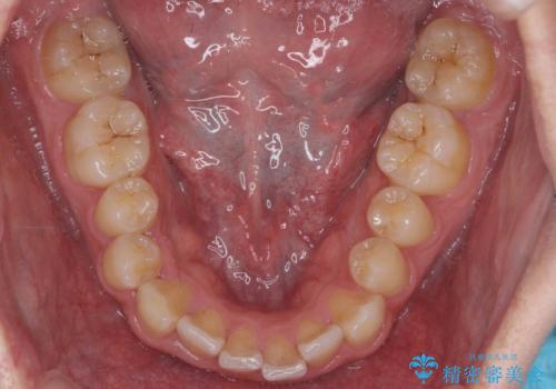 前歯のすき間、犬歯の異所萌出　乳歯を抜かずに矯正の治療前