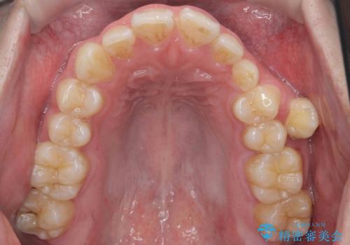 前歯のすき間、犬歯の異所萌出 乳歯を抜かずに矯正の治療前