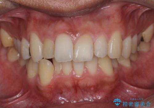前歯をやむなく抜歯 ブリッジに 治療ついでに歯並びもよくの治療前