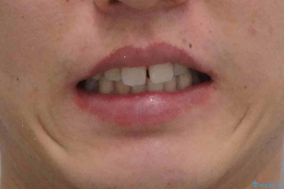 前歯のすき間、犬歯の異所萌出 乳歯を抜かずに矯正の治療前(顔貌)