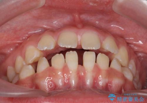 人の印象は歯並びから! 実は…美容医療より効果抜群!! コスパ重視ならすきっ歯の矯正治療の治療前