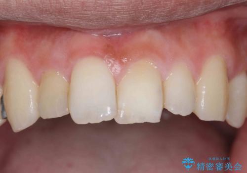 前歯をやむなく抜歯　ブリッジに　治療ついでに歯並びもよくの症例 治療前