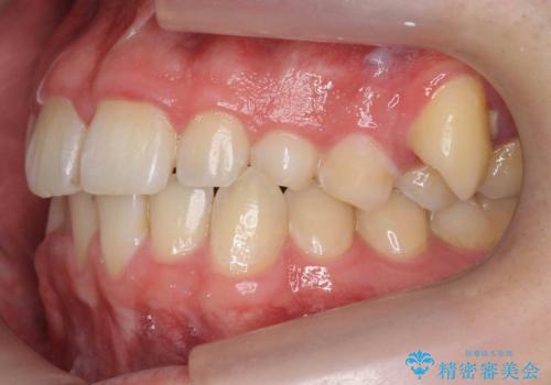 前歯のすき間、犬歯の異所萌出 乳歯を抜かずに矯正の治療前