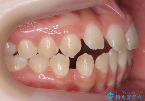 人の印象は歯並びから! 実は…美容医療より効果抜群!! コスパ重視ならすきっ歯の矯正治療の治療前