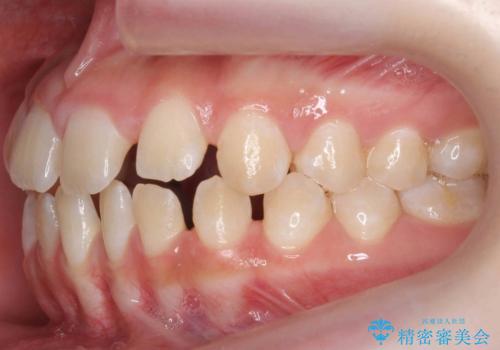 人の印象は歯並びから! 実は…美容医療より効果抜群!! コスパ重視ならすきっ歯の矯正治療の治療前