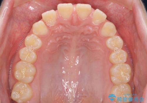 人の印象は歯並びから! 実は…美容医療より効果抜群!! コスパ重視ならすきっ歯の矯正治療の治療前