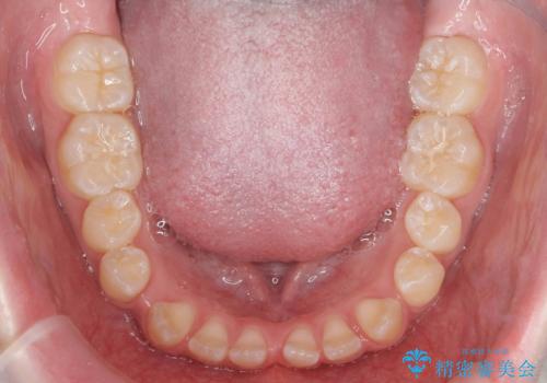 人の印象は歯並びから! 実は…美容医療より効果抜群!! コスパ重視ならすきっ歯の矯正治療の治療前