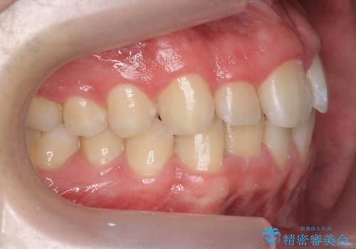 前歯のすき間、犬歯の異所萌出 乳歯を抜かずに矯正の治療前