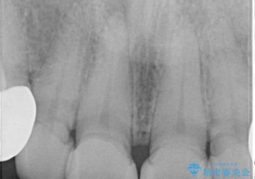【セラミッククラウン】他院で治療したセラミッククラウンをやりかえたいの治療前