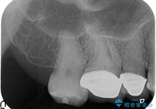 伸びてしまった奥歯、咬合平面を揃えたインプラント治療の治療中
