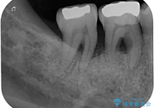 不正咬合で抜歯となった奥歯　インプラントによる咬合回復の治療前