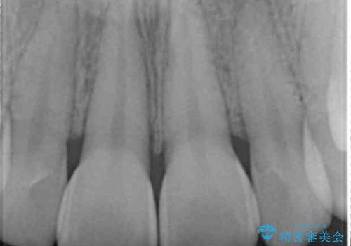 前歯の変色　打撲により失活した前歯の根管・セラミック治療の治療前